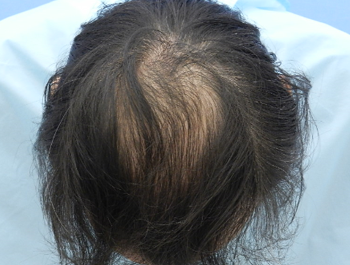 薄毛治療 発毛症例 42歳/MO型/初診時