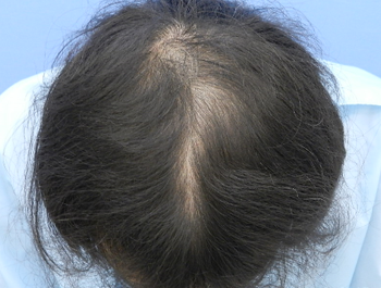 薄毛治療 発毛症例 42歳/MO型/7ヶ月後