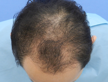 薄毛治療 発毛症例 39歳/MO型/初診時