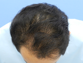 薄毛治療 発毛症例 39歳/MO型/7ヶ月後