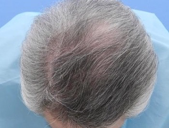 薄毛治療 発毛症例 52歳/O型/5ヶ月後