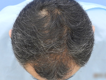 薄毛治療 発毛症例 51歳/MO型/5ヶ月後
