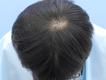 薄毛治療 発毛症例 24歳/O型/5ヶ月後