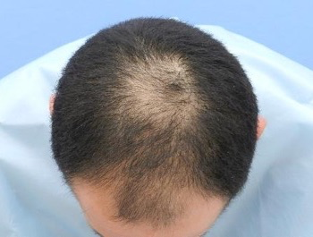 薄毛治療 発毛症例 35歳/MO型/初診時