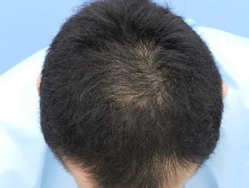 薄毛治療 発毛症例 35歳/MO型/5ヶ月後