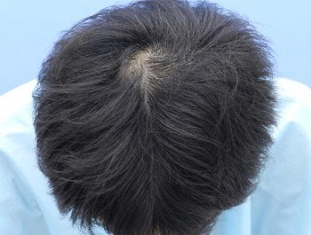 薄毛治療 発毛症例 29歳/O型/5ヶ月後