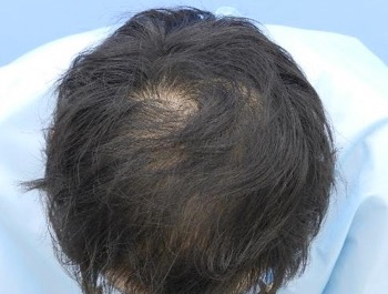 薄毛治療 発毛症例 28歳/MO型/5ヶ月後