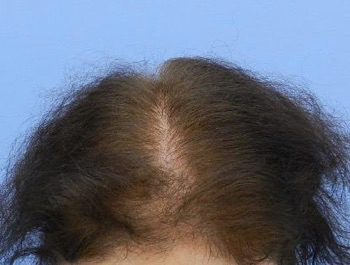 薄毛治療 発毛症例 56歳/全体/6ヶ月後