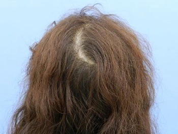 薄毛治療 発毛症例 54歳/頭頂部/5ヶ月後