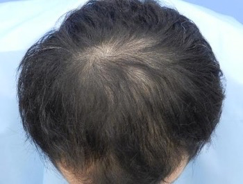 薄毛治療 発毛症例 33歳/MO型/7ヶ月後