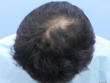 薄毛治療 発毛症例 39歳/O型/6ヶ月後
