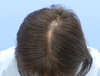 薄毛治療 発毛症例 47歳/頭頂部/6ヶ月後