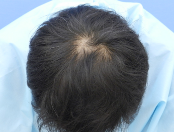 薄毛治療 発毛症例 41歳/MO型/8ヶ月後