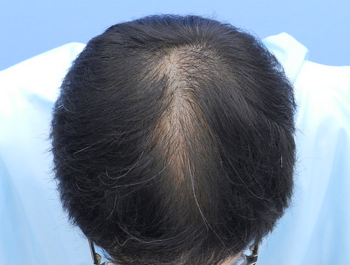 薄毛治療 発毛症例 47歳/O型/7ヶ月後