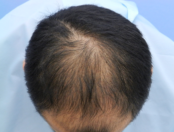 薄毛治療 発毛症例 32歳/MO型/13ヶ月後