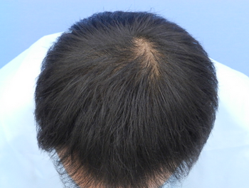 AGA治療例:45歳/MO型/薄毛歴5年/会社役員/3ヶ月後
