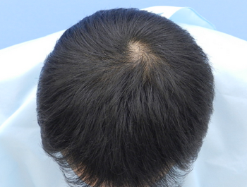 薄毛治療 発毛症例 45歳/MO型/5ヶ月後