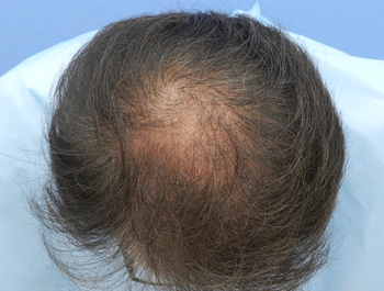 薄毛治療 発毛症例 55歳/MO型/初診時