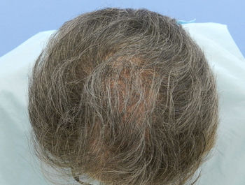 薄毛治療 発毛症例 55歳/MO型/9ヶ月後