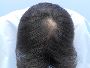 薄毛治療 発毛症例 33歳/MO型/6ヶ月後