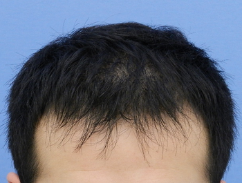 薄毛治療 発毛症例 31歳/MO型/5ヶ月後