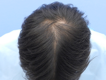 薄毛治療 発毛症例 30歳/MO型/初診時