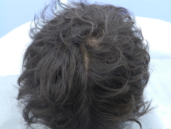 薄毛治療 発毛症例 30歳/MO型/5ヶ月後