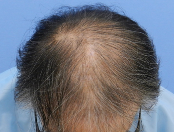 薄毛治療 発毛症例 56歳/MO型/初診時
