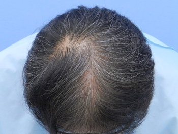 薄毛治療 発毛症例 56歳/MO型/9ヶ月後