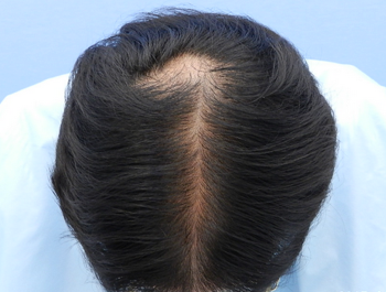 薄毛治療 発毛症例 48歳/MO型/初診時