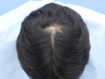 薄毛治療 発毛症例 48歳/MO型/7ヶ月後