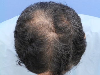 薄毛治療 発毛症例 64歳/O型/7ヶ月後