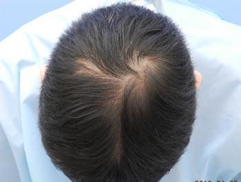 薄毛治療 発毛症例 36歳/MO型/7ヶ月後