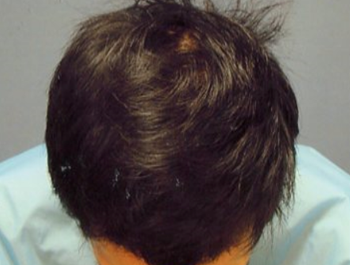薄毛治療 発毛症例 28歳/MO型/7ヶ月後
