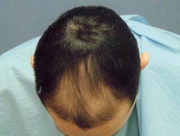 薄毛治療 発毛症例 37歳/M型/初診時