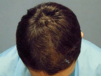 薄毛治療 発毛症例 37歳/M型/13ヶ月後