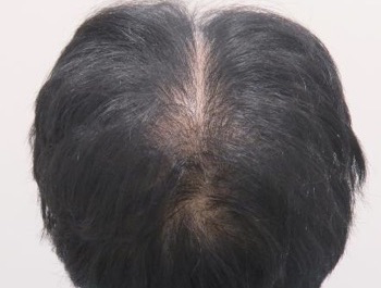 薄毛治療 発毛症例 49歳/全体/初診時