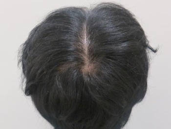 薄毛治療 発毛症例 49歳/全体/8ヶ月後