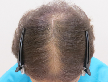 AGA治療例:70歳/頭頂部/薄毛歴1年//6ヶ月後
