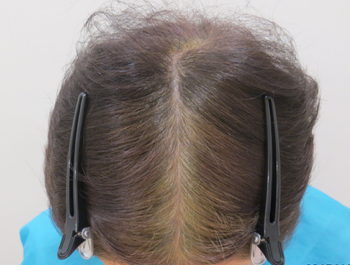 薄毛治療 発毛症例 70歳/頭頂部/8ヶ月後