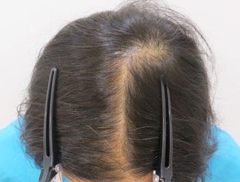 AGA治療例:57歳/頭頂部/薄毛歴2年//6ヶ月後