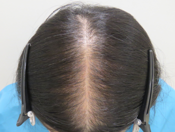 薄毛治療 発毛症例 51歳/頭頂部/12ヶ月後