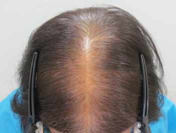 薄毛治療 発毛症例 59歳/頭頂部/初診時