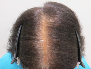 AGA治療例:59歳/頭頂部/薄毛歴4年/主婦/6ヶ月後
