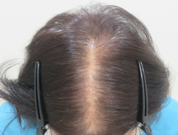 AGA治療例:59歳/頭頂部/薄毛歴4年/主婦/9ヶ月後