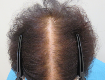 AGA治療例:77歳/頭頂部/薄毛歴1年//4ヶ月後