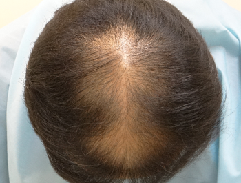 薄毛治療 発毛症例 44歳/O型/初診時