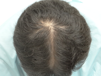 薄毛治療 発毛症例 44歳/O型/12ヶ月後