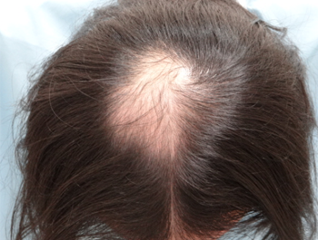 薄毛治療 発毛症例 40歳/O型/初診時