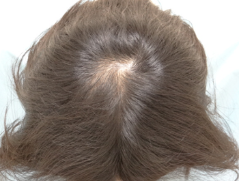 薄毛治療 発毛症例 40歳/O型/6ヶ月後